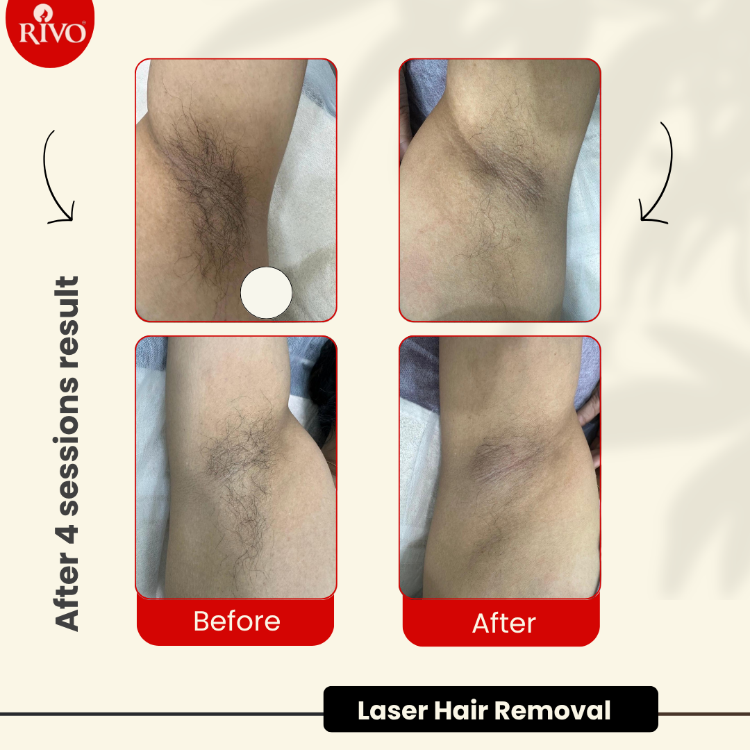 Laser Hair Removal - Result 03