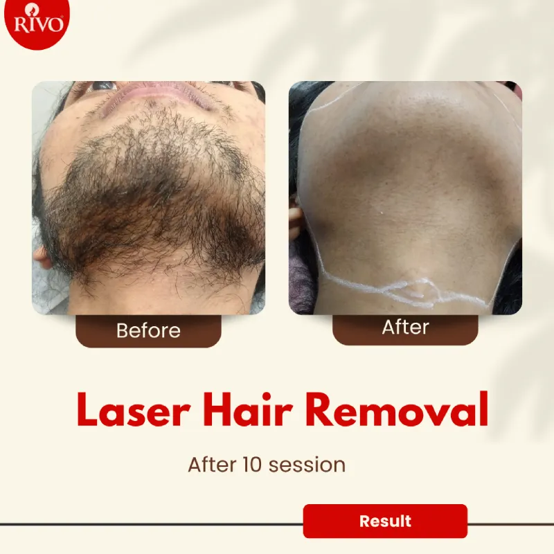 Laser-Hair-Removal-Result